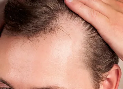 Yorgain Hair Care Experts Androgenetic-Alopecia