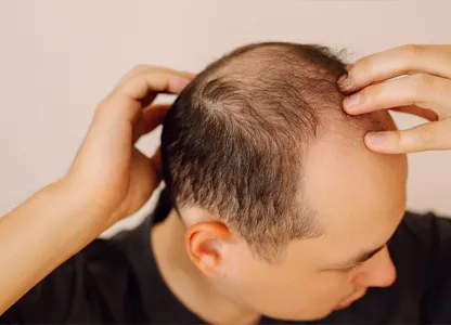 Yorgain Hair Care Experts Nutritional-Deficiency-Hair-Loss