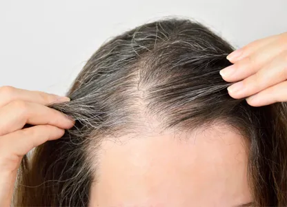 Yorgain Hair Care Experts Telogen-Effluvium